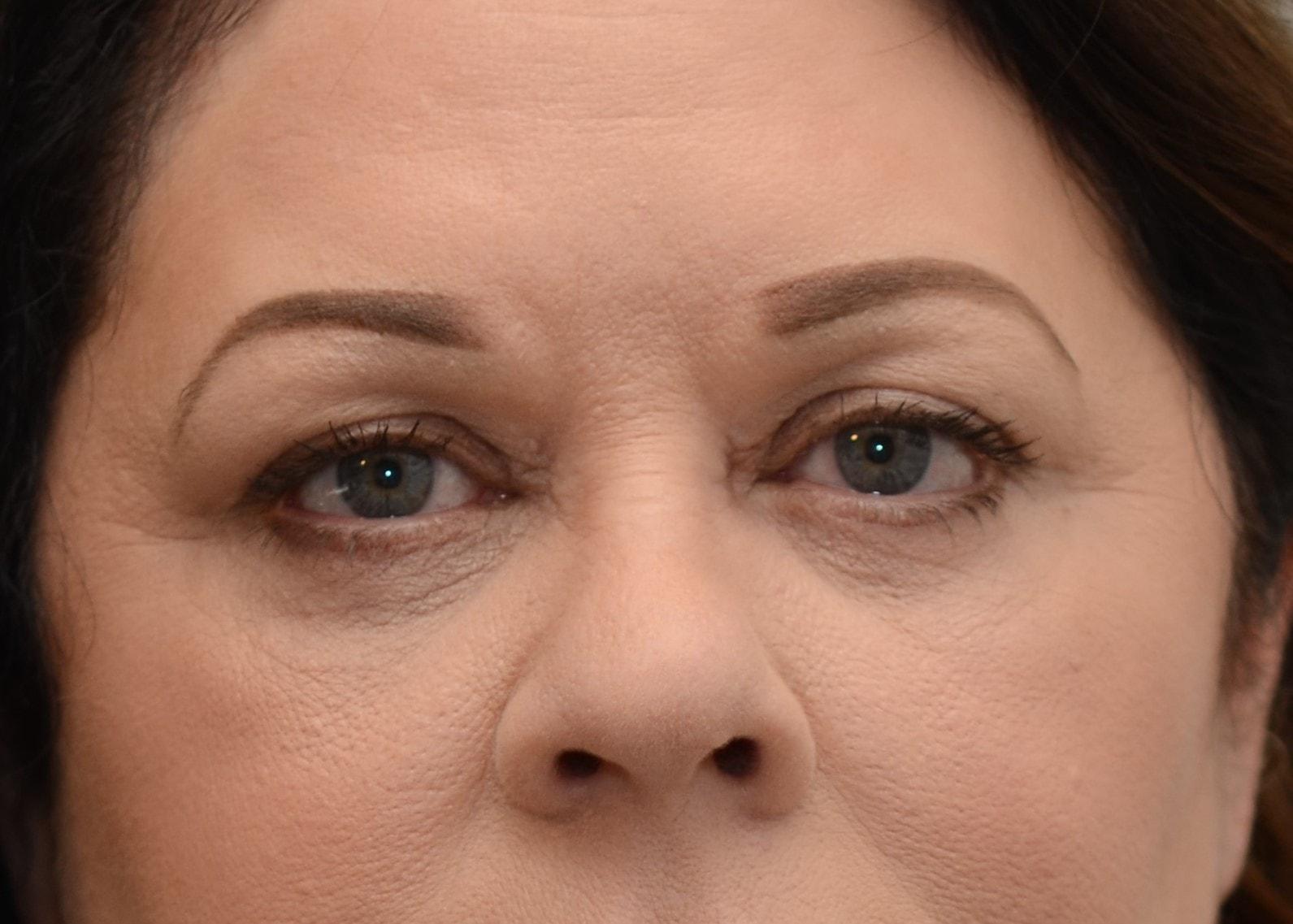 Amadi Aesthetics Plastic Surgery eyelid lift after — Mercer Island, WA