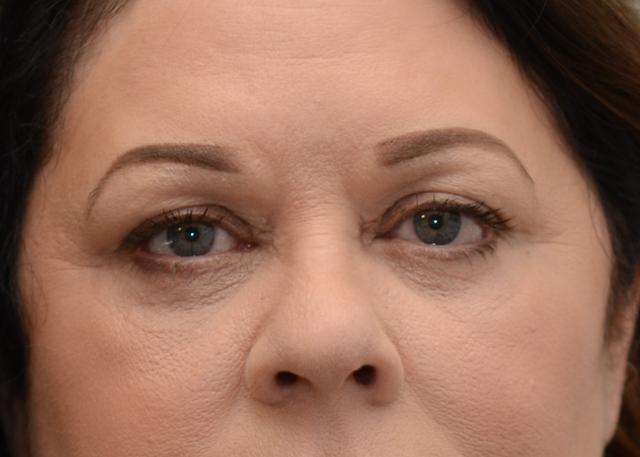 Blepharoplasty after at Amadi Aesthetics Plastic Surgery in Mercer Island, WA