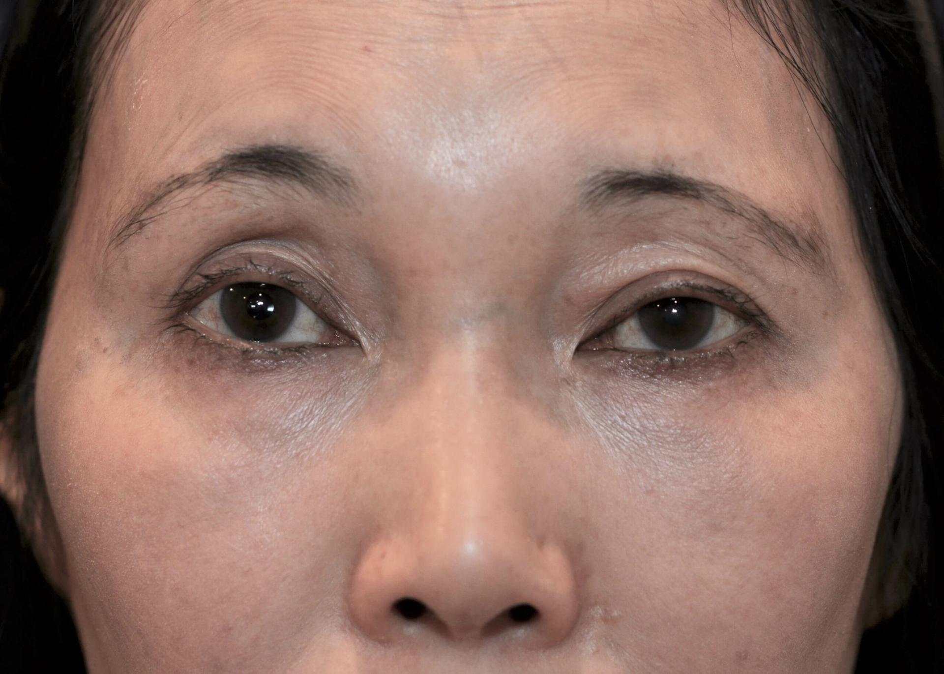 Amadi Aesthetics Plastic Surgery fat transfer after — Mercer Island, WA