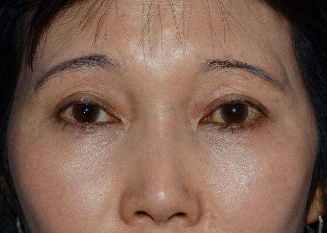 Fat Transfer before at Amadi Aesthetics Plastic Surgery in Mercer Island, WA