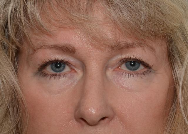 Blepharoplasty before at Amadi Aesthetics Plastic Surgery in Mercer Island, WA