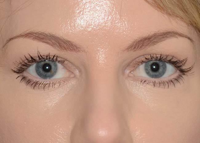 Amadi Aesthetics Plastic Surgery blepharoplasty after — Mercer Island, WA