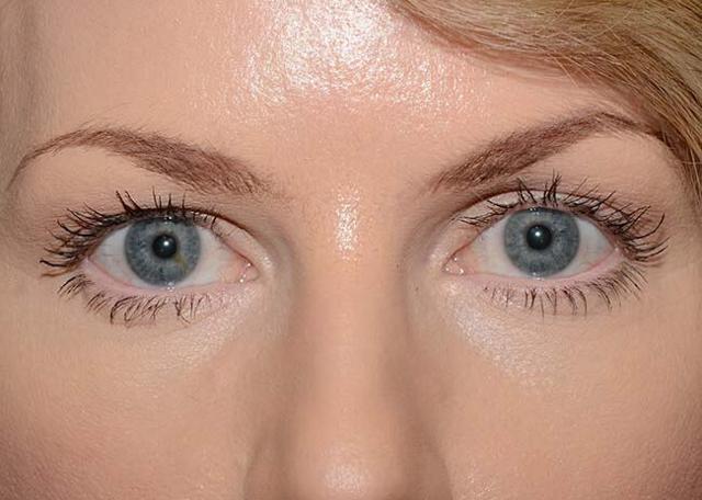 Blepharoplasty before at Amadi Aesthetics Plastic Surgery in Mercer Island, WA