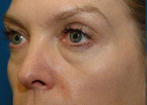 Fat Transfer before at Amadi Aesthetics Plastic Surgery in Mercer Island, WA
