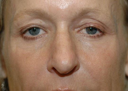 Fat Transfer before at Amadi Aesthetics Plastic Surgery in Mercer Island, WA