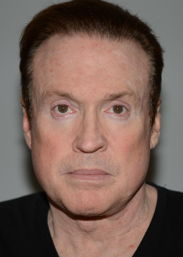 Laser Skin Resurfacing before at Amadi Aesthetics Plastic Surgery in Mercer Island, WA