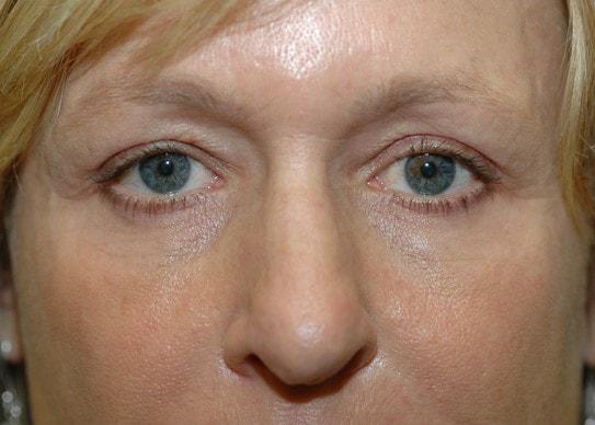 Fat Transfer after at Amadi Aesthetics Plastic Surgery in Mercer Island, WA