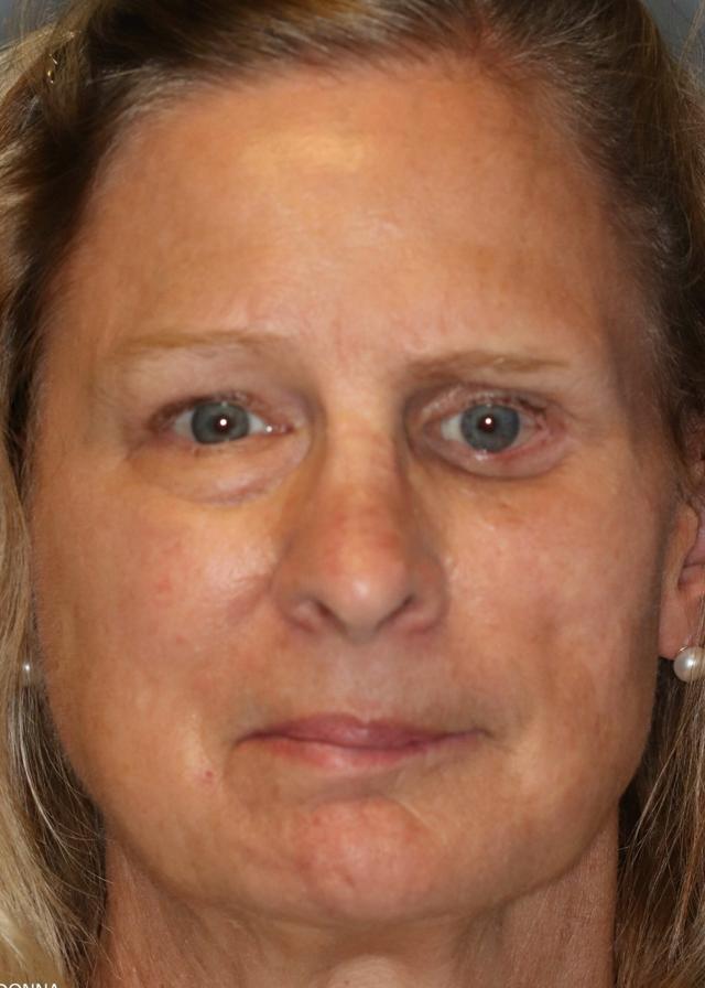 Brazilian Butt Lift after at Amadi Aesthetics Plastic Surgery in Mercer Island, WA