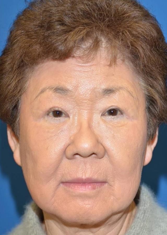 Laser Skin Resurfacing after at Amadi Aesthetics Plastic Surgery in Mercer Island, WA