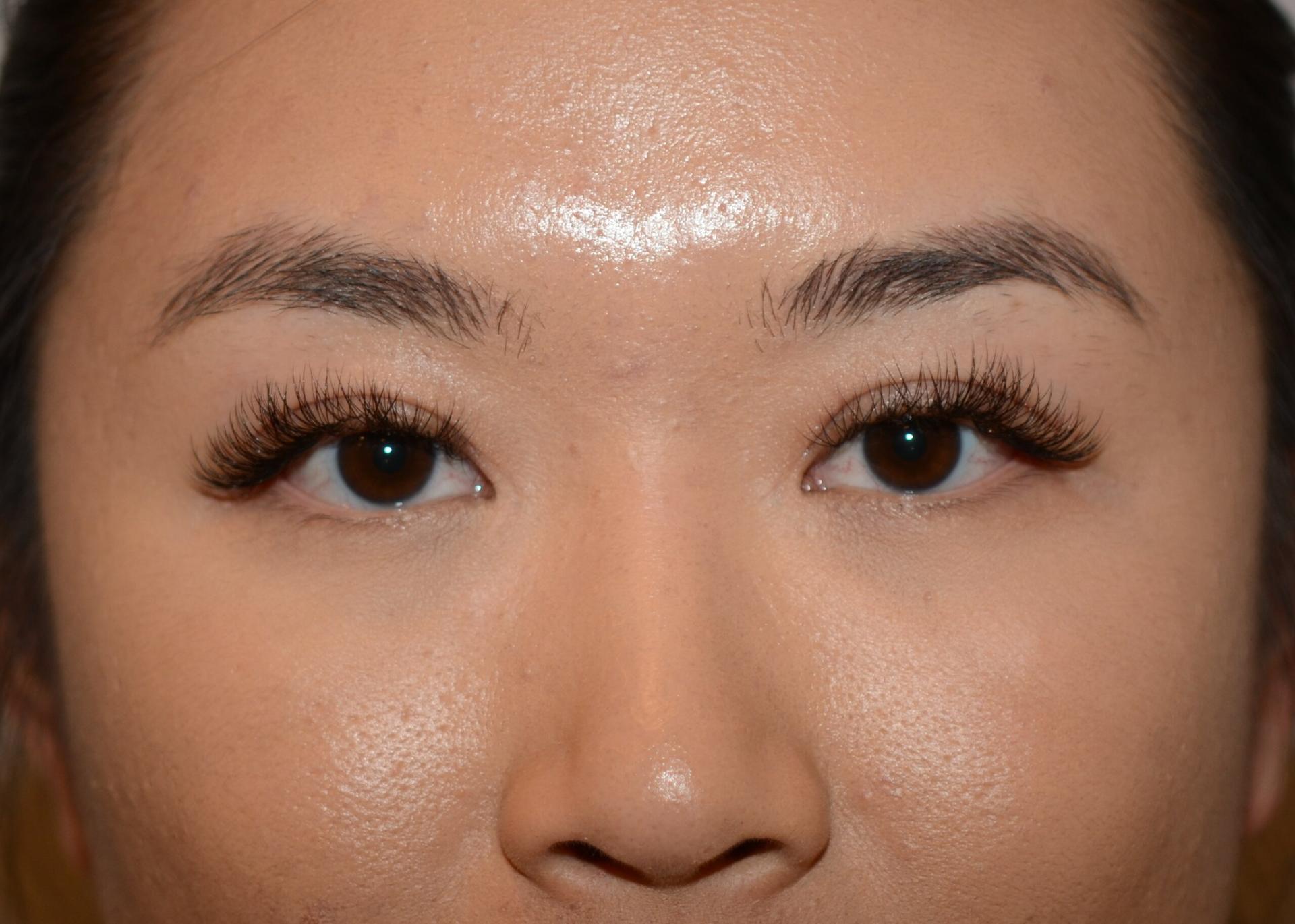 Amadi Aesthetics Plastic Surgery blepharoplasty after — Mercer Island, WA