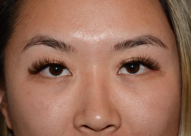 Blepharoplasty before at Amadi Aesthetics Plastic Surgery in Mercer Island, WA