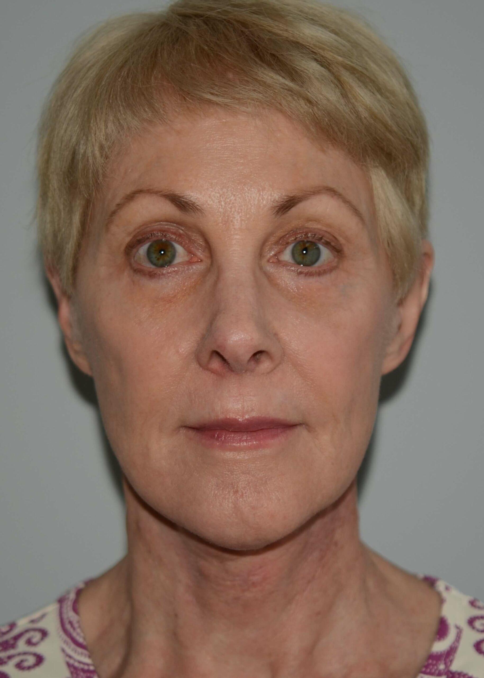 Amadi Aesthetics Plastic Surgery after — Mercer Island, WA