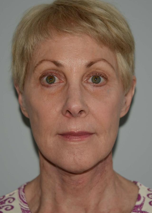 Neck Lift after at Amadi Aesthetics Plastic Surgery in Mercer Island, WA