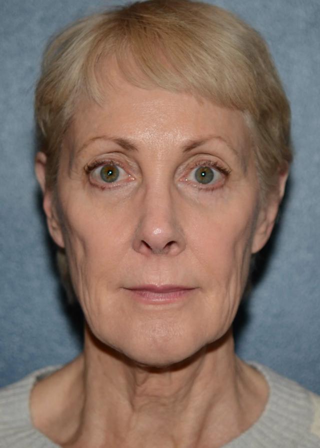 Neck Lift before at Amadi Aesthetics Plastic Surgery in Mercer Island, WA