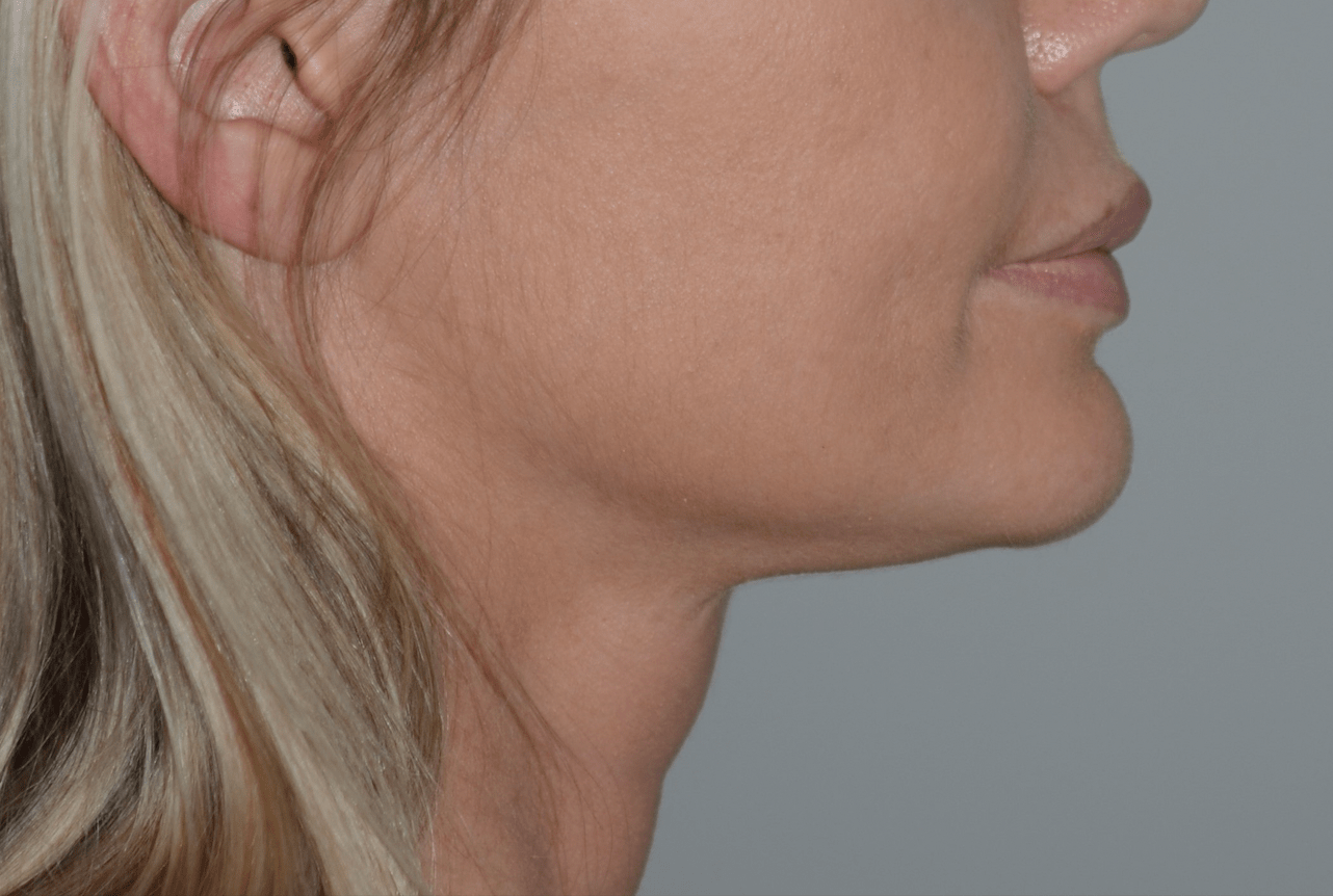 Amadi Aesthetics Plastic Surgery after — Mercer Island, WA