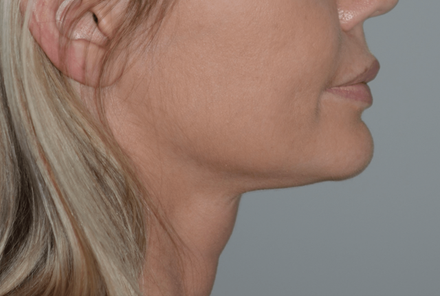 Neck Lift after at Amadi Aesthetics Plastic Surgery in Mercer Island, WA
