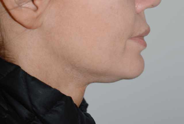 Neck Lift before at Amadi Aesthetics Plastic Surgery in Mercer Island, WA