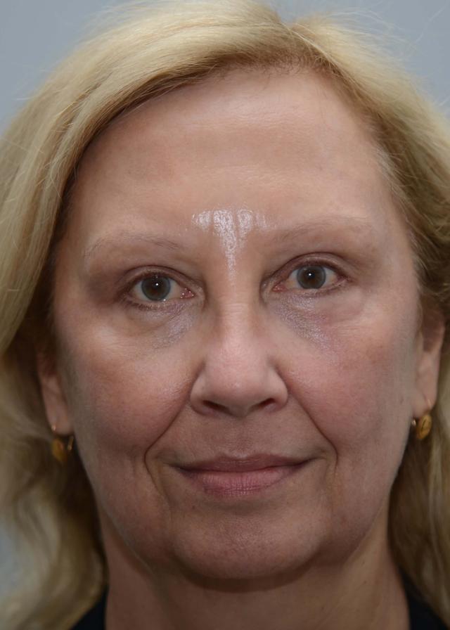 Laser Skin Resurfacing after at Amadi Aesthetics Plastic Surgery in Mercer Island, WA