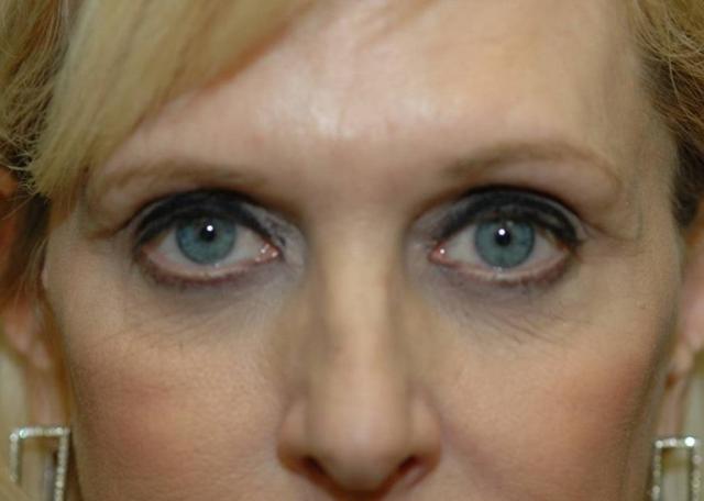 Laser Skin Resurfacing before at Amadi Aesthetics Plastic Surgery in Mercer Island, WA