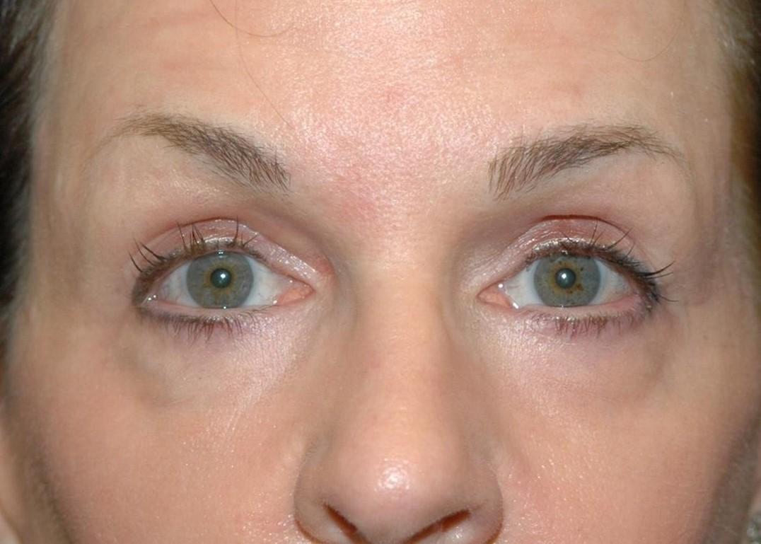 Amadi Aesthetics Plastic Surgery blepharoplasty after — Mercer Island, WA