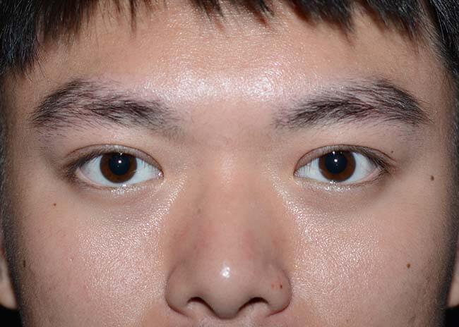 Amadi Aesthetics Plastic Surgery blepharoplasty after — Mercer Island, WA