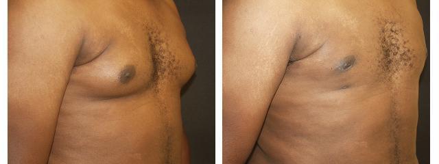 Gynecomastia Surgery result at Desired Beauty Surgical & Medical Center; Dr. Farzin Kerendian, DO in Century City, CA