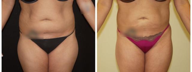 Desired Beauty Surgical & Medical Center; Dr. Farzin Kerendian, DO liposuction result — Century City, CA