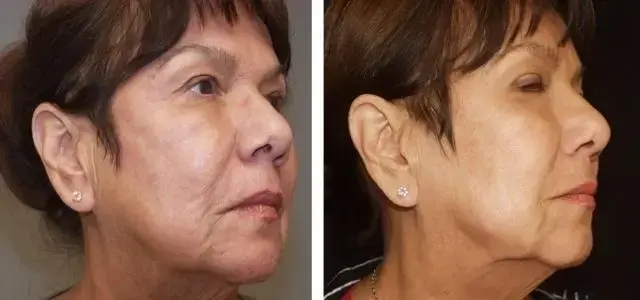 Desired Beauty Surgical & Medical Center; Dr. Farzin Kerendian, DO laser treatment result — Century City, CA