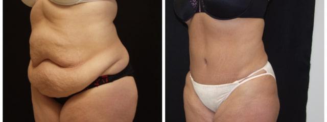 Desired Beauty Surgical & Medical Center; Dr. Farzin Kerendian, DO tummy tuck result — Century City, CA