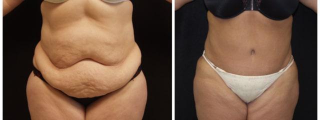 Desired Beauty Surgical & Medical Center; Dr. Farzin Kerendian, DO tummy tuck result — Century City, CA