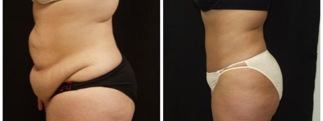 Tummy Tuck result at Desired Beauty Surgical & Medical Center; Dr. Farzin Kerendian, DO in Century City, CA
