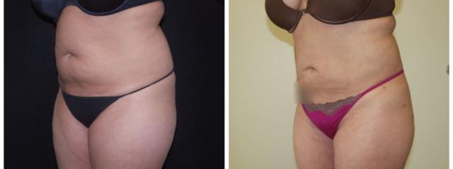 Liposuction result at Desired Beauty Surgical & Medical Center; Dr. Farzin Kerendian, DO in Century City, CA