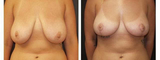 Breast Reduction result at Desired Beauty Surgical & Medical Center; Dr. Farzin Kerendian, DO in Century City, CA