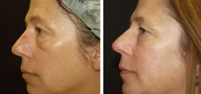 Desired Beauty Surgical & Medical Center; Dr. Farzin Kerendian, DO laser treatment result — Century City, CA