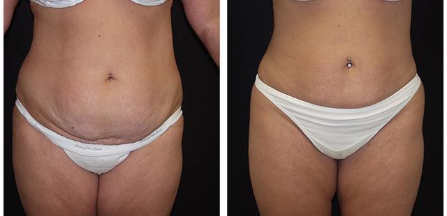 Brazilian Butt Lift result at Desired Beauty Surgical & Medical Center; Dr. Farzin Kerendian, DO in Century City, CA