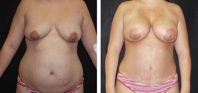 Mommy Makeover result at Desired Beauty Surgical & Medical Center; Dr. Farzin Kerendian, DO in Century City, CA