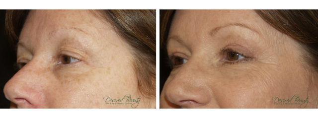 Blepharoplasty result at Desired Beauty Surgical & Medical Center; Dr. Farzin Kerendian, DO in Century City, CA