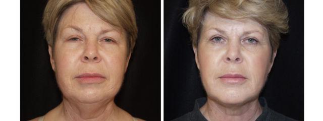 Chin Implant result at Desired Beauty Surgical & Medical Center; Dr. Farzin Kerendian, DO in Century City, CA