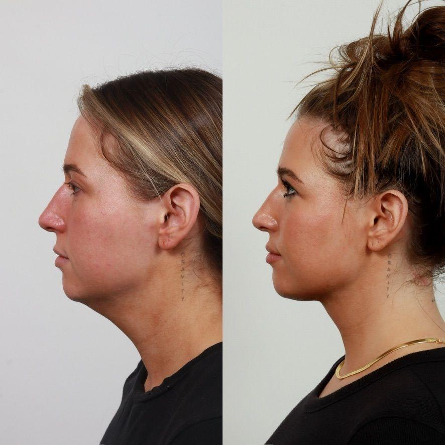 Locketz Facial Plastic Surgery neck lift result — Centennial, CO