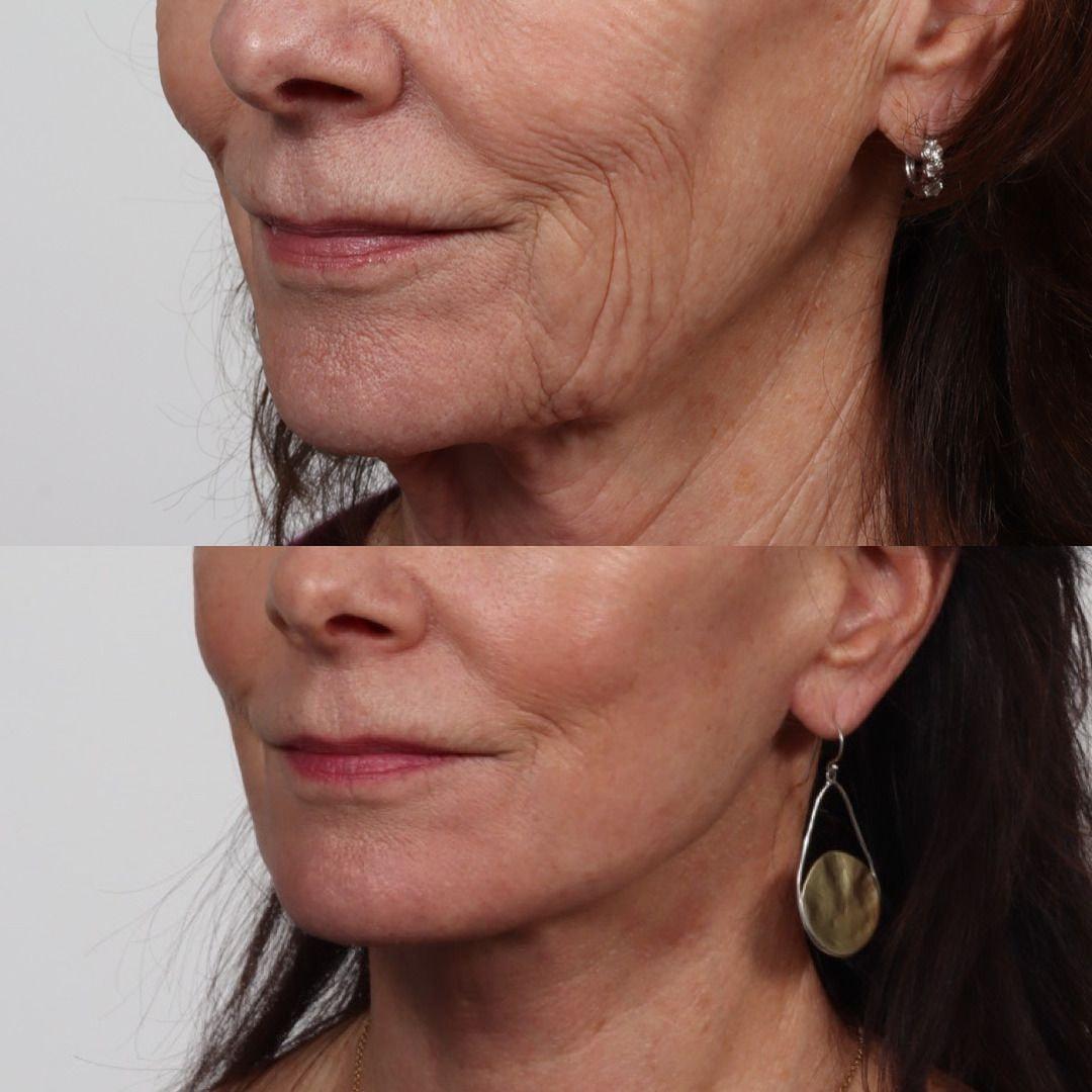 Locketz Facial Plastic Surgery facelift result — Centennial, CO