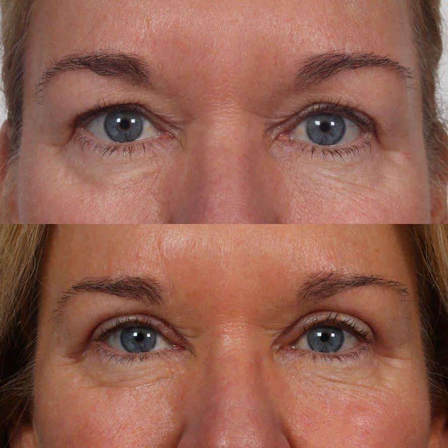 Locketz Facial Plastic Surgery eyelid lift result — Centennial, CO