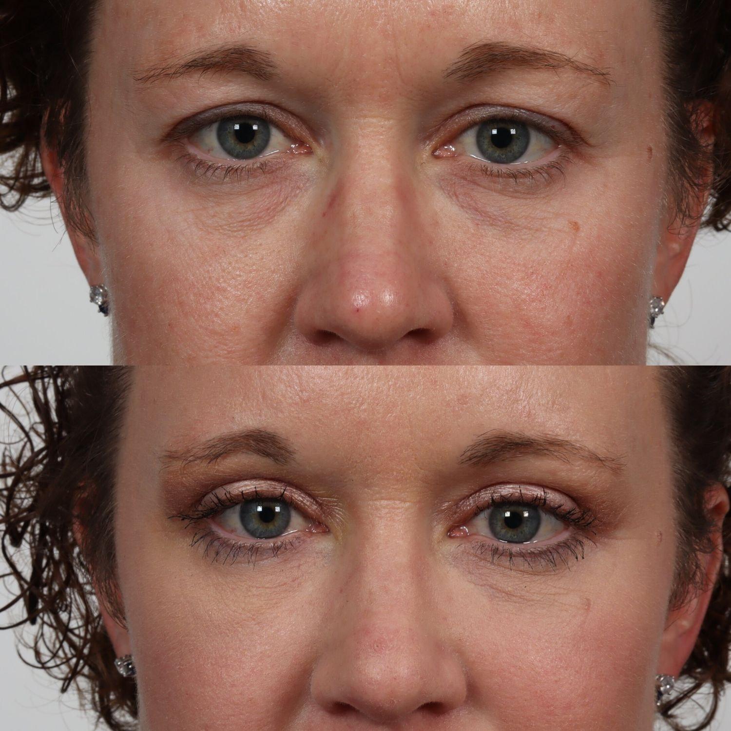 Locketz Facial Plastic Surgery eyelid lift result — Centennial, CO