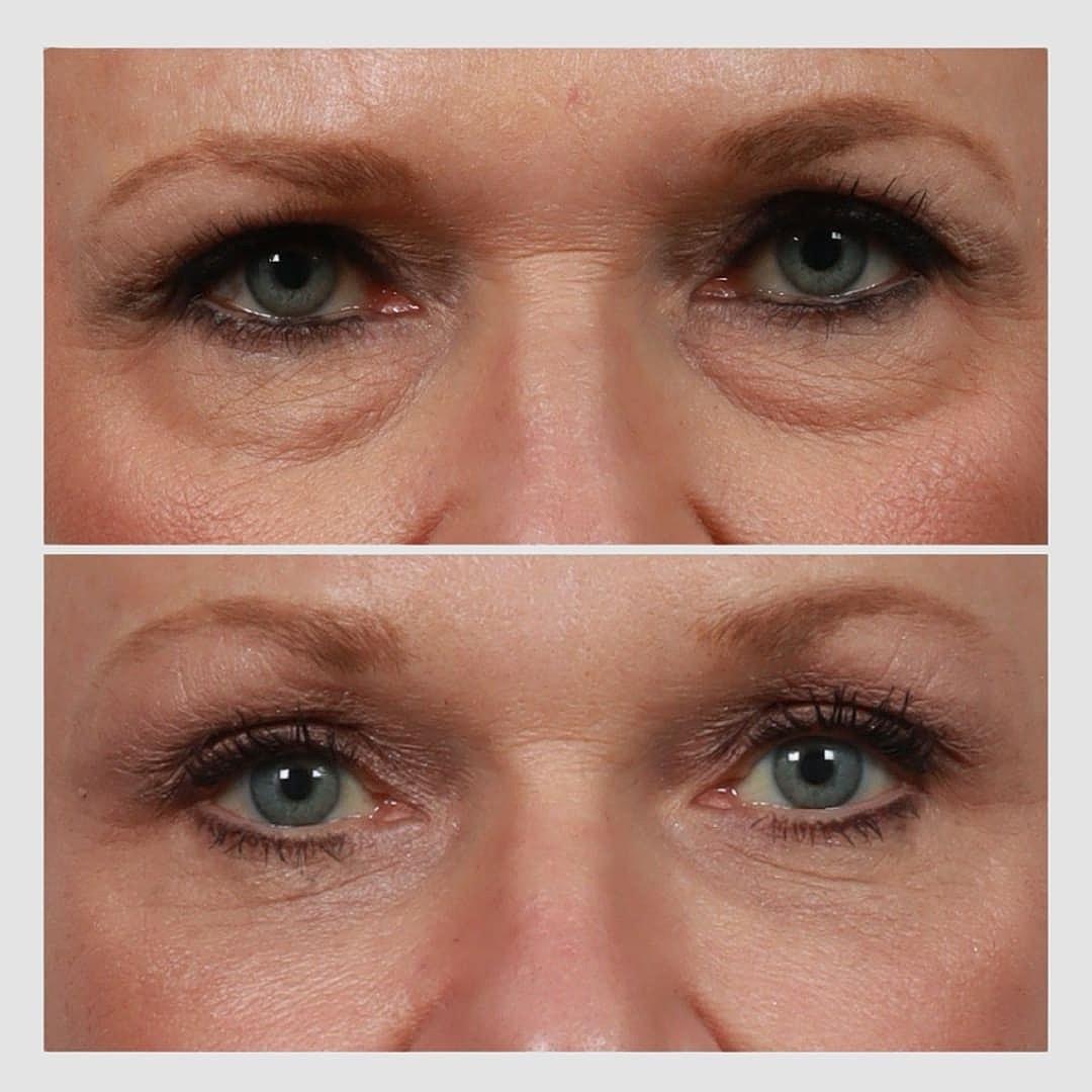 Locketz Facial Plastic Surgery eyelid lift result — Centennial, CO
