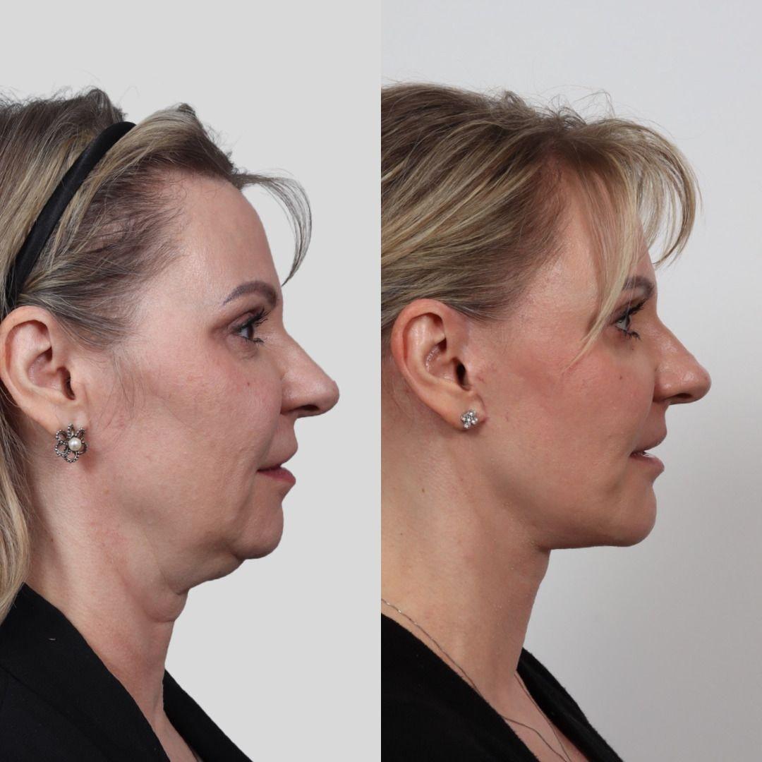 Locketz Facial Plastic Surgery facelift result — Centennial, CO