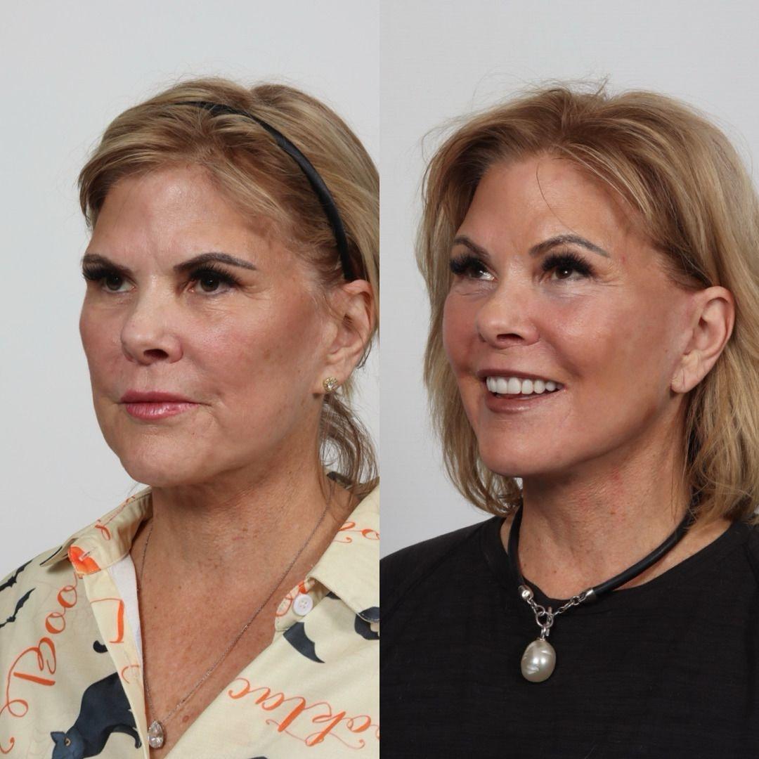 Locketz Facial Plastic Surgery facelift result — Centennial, CO