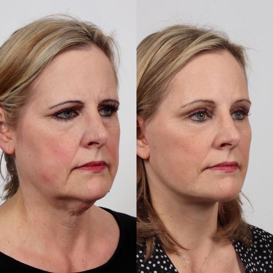Locketz Facial Plastic Surgery facelift result — Centennial, CO