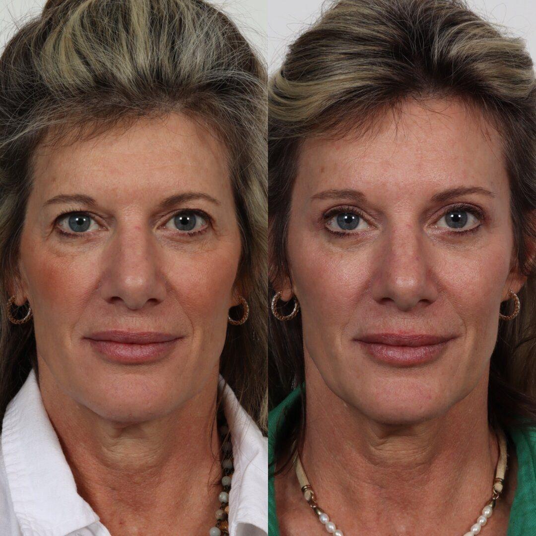 Locketz Facial Plastic Surgery eyelid lift result — Centennial, CO