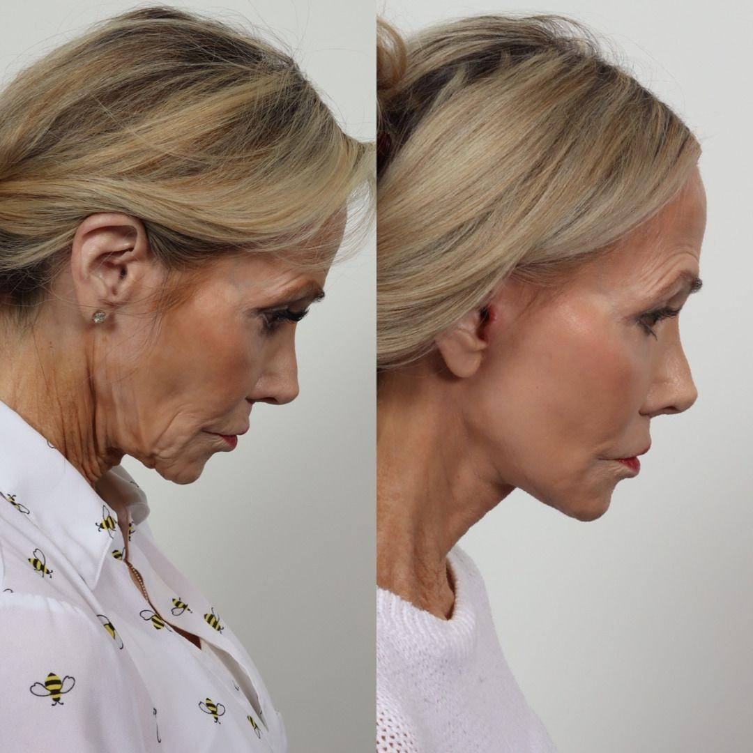 Locketz Facial Plastic Surgery facelift result — Centennial, CO