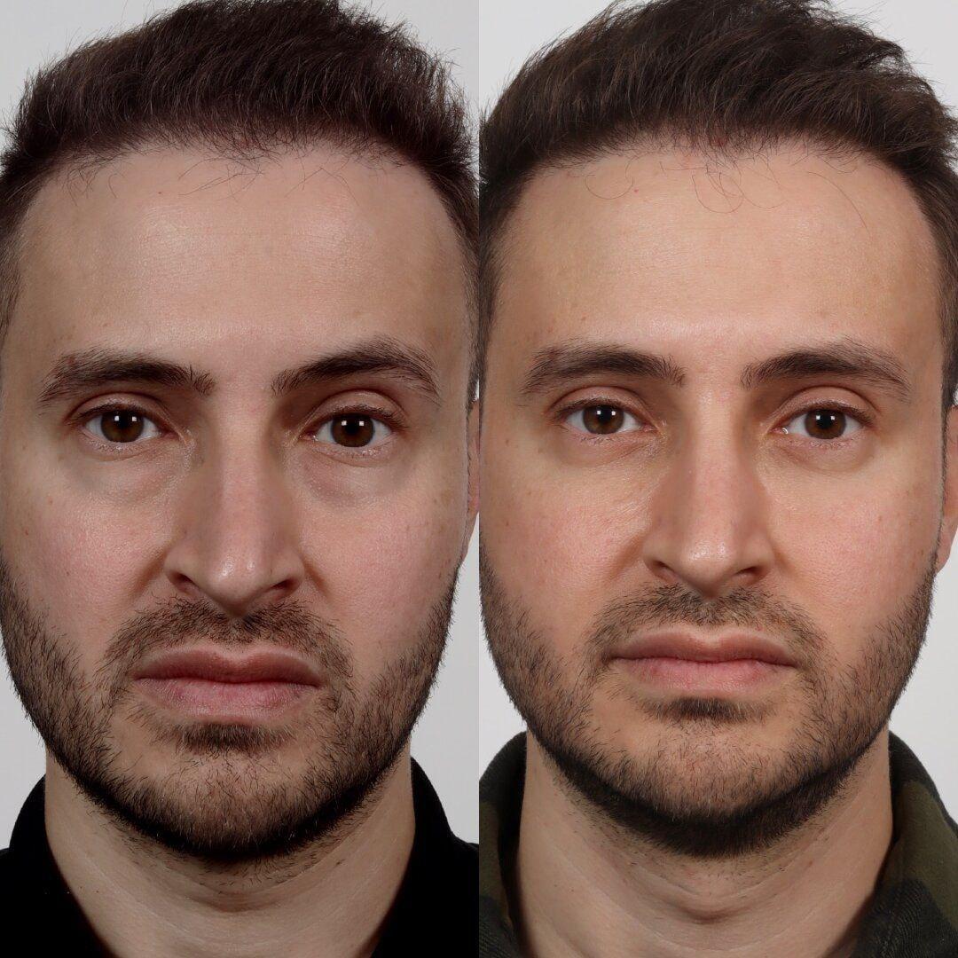 Locketz Facial Plastic Surgery eyelid lift result — Centennial, CO
