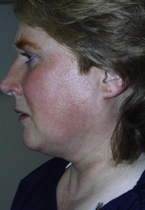 Neck Liposuction before at Cosmetic Surgery & Dermatology of Issaquah in Issaquah, WA